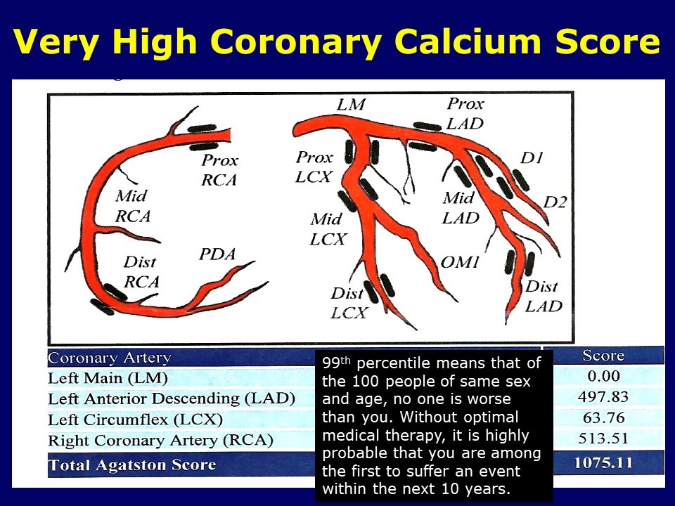 Very High Coronary Calcium Score